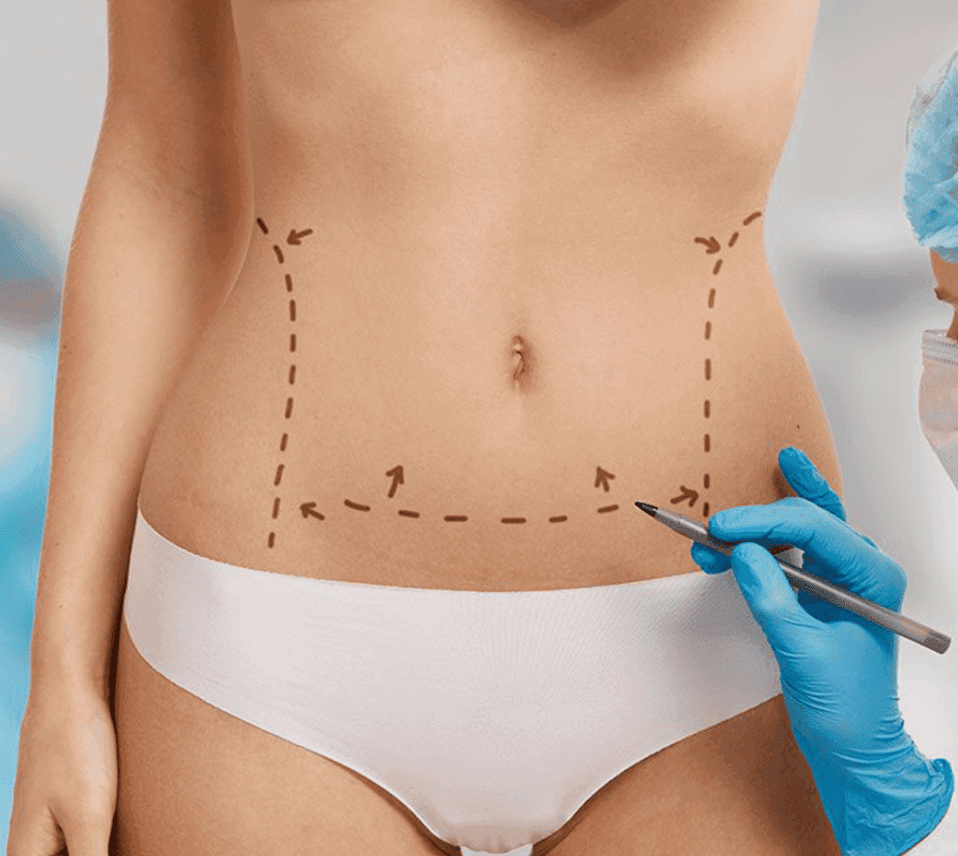 Tummy Tuck