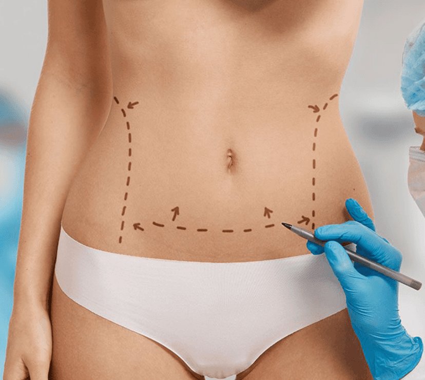 Tummy Tuck