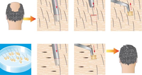 FUE Technique Hair Transplant in Turkey​