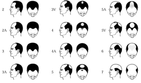 Hair Transplant Norwood Scale​