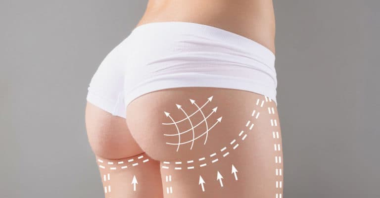 Brazilian Butt Lift Worth It?―The Truth​