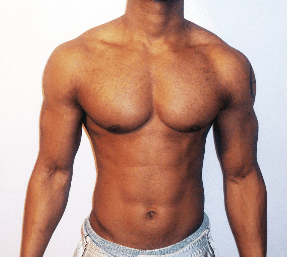 Gynecomastia