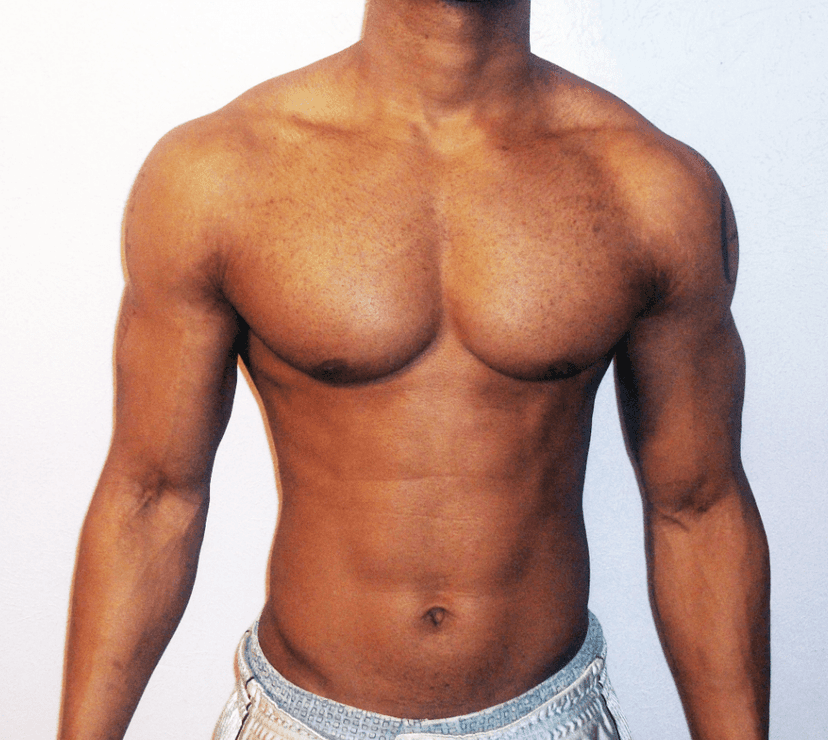 Gynecomastia