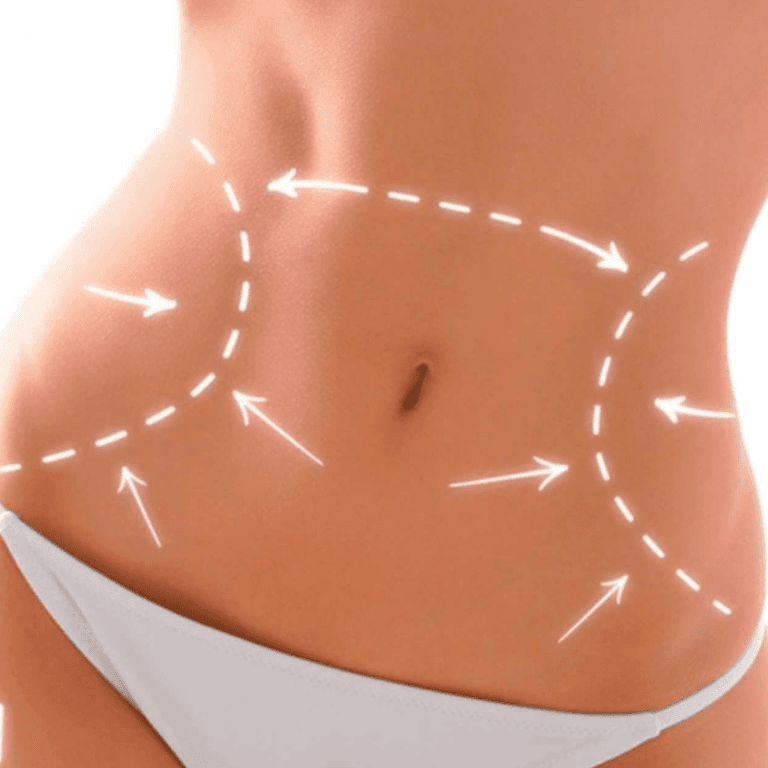 Tummy tuck image