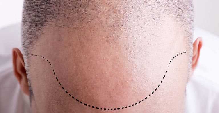 Still losing hair in year 2022? What may be the reasons?​