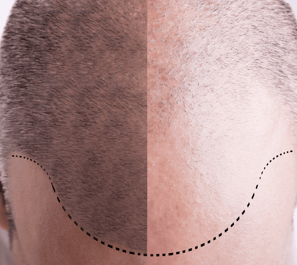 Hair Transplant