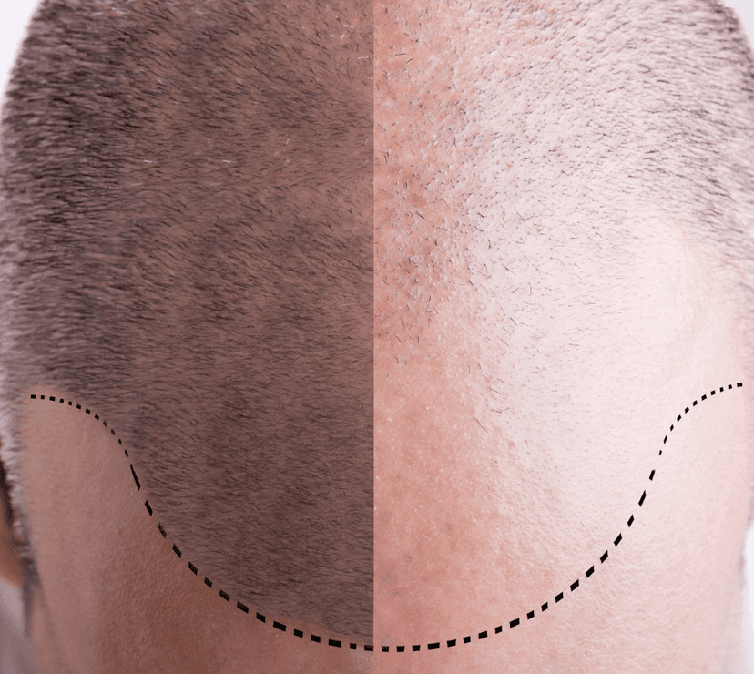 FUE Hair Transplant