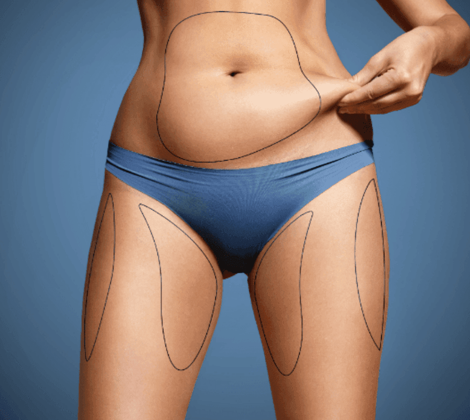 Liposuction